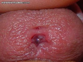 stretched pee hole after sounding