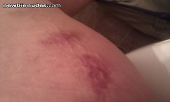 Bruises on a slave